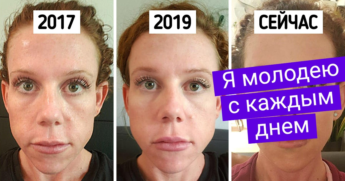 15 смельчаков, которые поделились обалденными результатами своих пластических операций