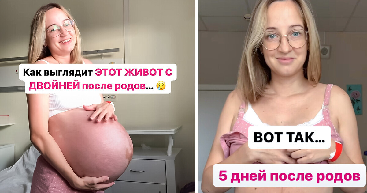 Женщина, родившая двойню, показала свой живот через 5 дней после родов вызвала недоумение пользователей сети
