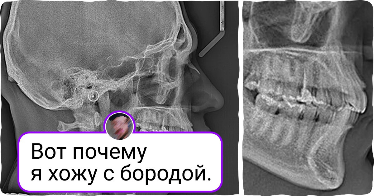 Обогащение легочного рисунка на рентгене что значит