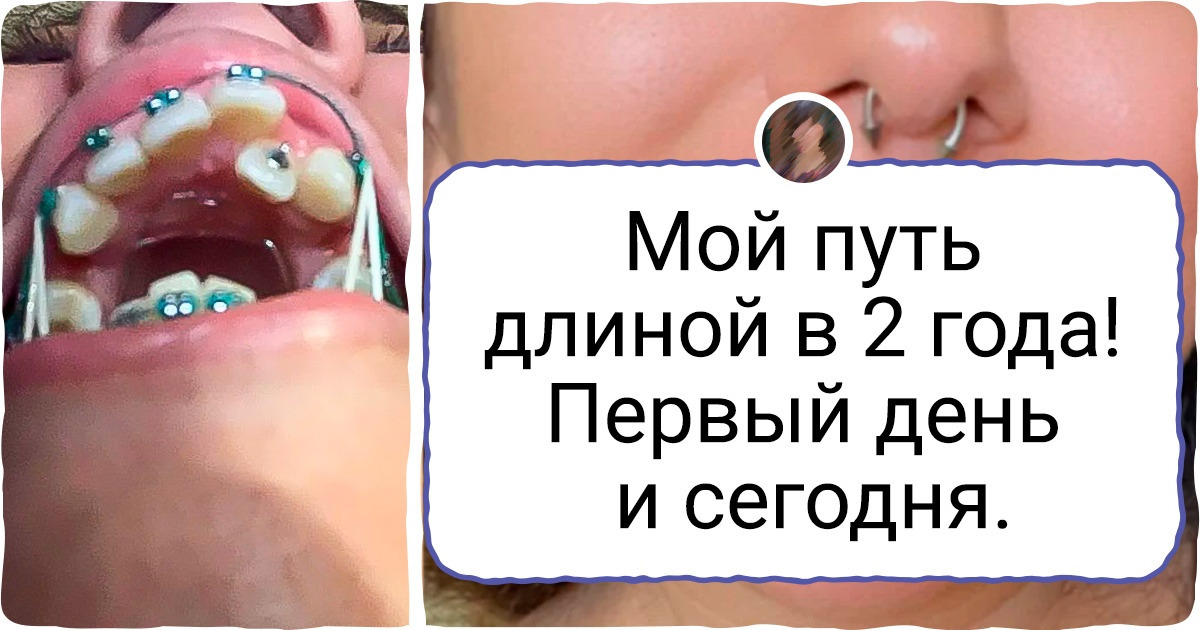 16 людей с удовольствием поделились фото своих зубов после брекетов