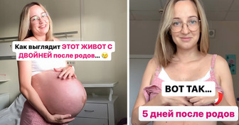 Женщина, родившая двойню, показала, как выглядит ее живот через 5 дней после родов, и отхватила уйму недовольства